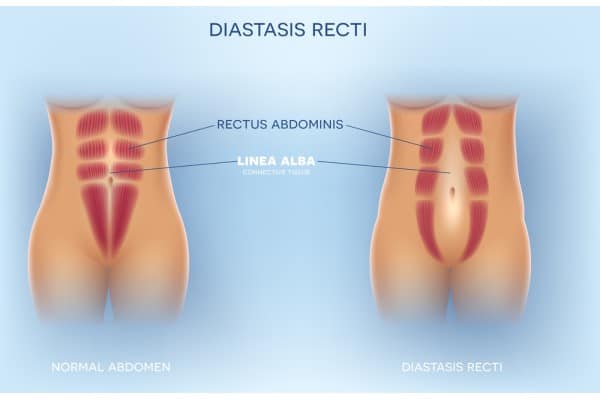 What Non-Surgical Options Are Available for Diastasis Recti Ascot?