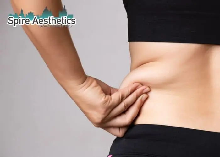 Image of woman pinching fat on their hips Ascot. Fat Freezing treatment