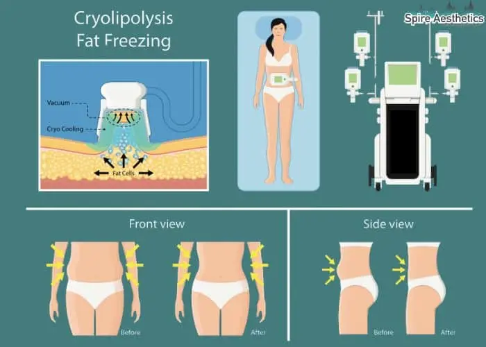 Fat freezing treatment Ascot benefits for competitions to remove stubborn fat deposits.