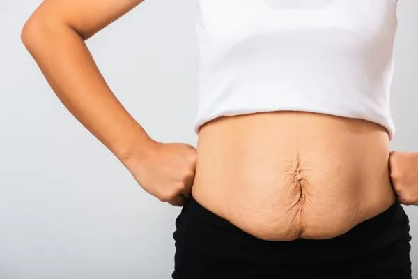 Image of a woman's stomach after weight loss with sagging skin following a gastric band Ascot