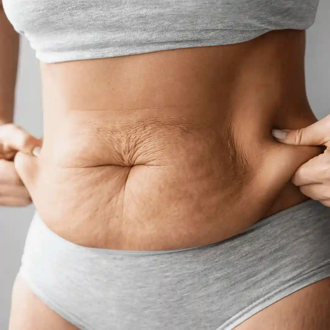 Is It Normal to Have Loose Skin After Pregnancy Ascot?