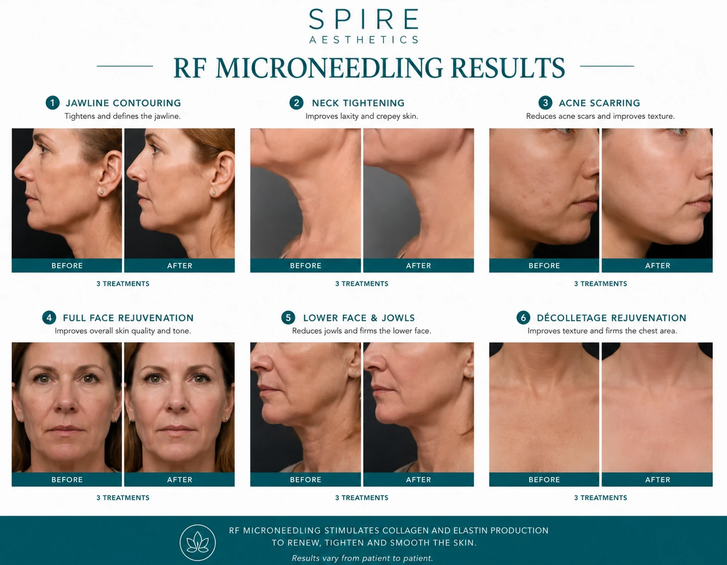 RF Microneedling Skin tightening Ascot results