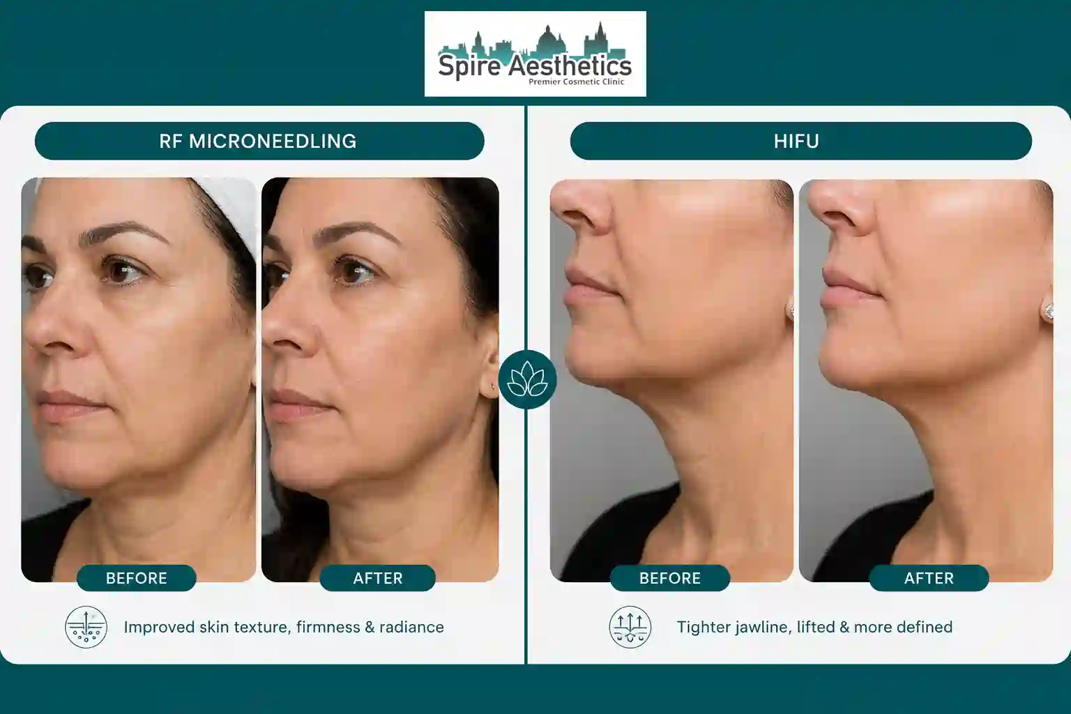 Can RF Microneedling and HIFU Be Combined Ascot?