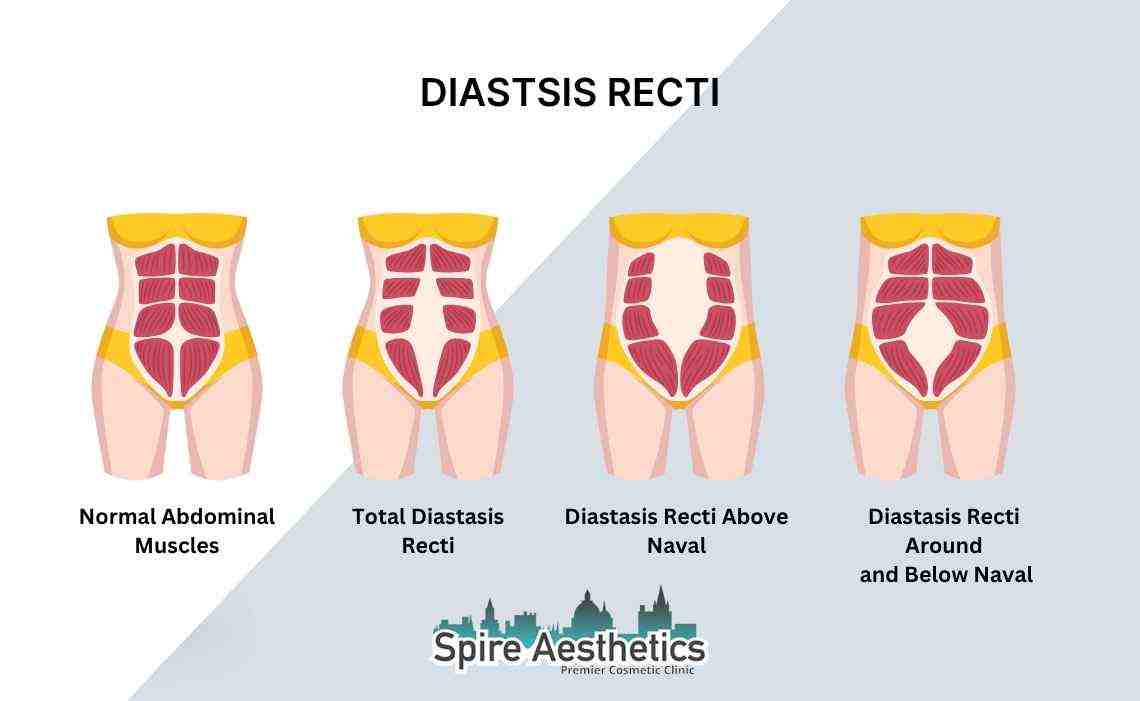 Is Non-Surgical Diastasis Recti Treatment Right for You? Common Concerns Answered Ascot